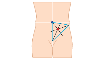 Stoma markering