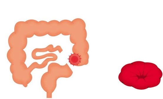 Vorming van een stoma