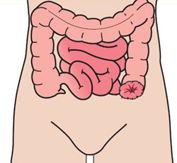 Colostomie
