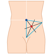 Stoma markering