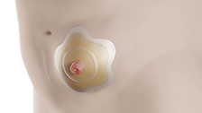 SenSura® Mio Concave voor stoma’s op een bolling